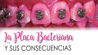 LA PLACA BACTERIANA sus consecuencias y tratamiento [upl. by Irallih]