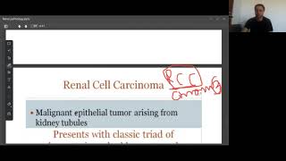 Renal cell carcinoma Renal pathology Pathoma in UrduHindi [upl. by Aicineohp]