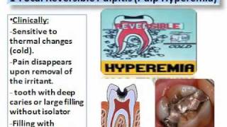 Pulp Diseases Oral Pathologywmv [upl. by Glaab]