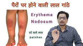 पैरों पर होने वाली लाल गांठे  दर्द वाले लाल patches  Red painful rashes amp bumps on legs erythema [upl. by Drawe]