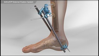 ArthroFX® External Fixation System [upl. by Dor393]