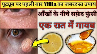 7 Days Challenge 😍 GET RID OF TINY BUMPS NATURALLY AT HOME  Milia Home Remedies  Milia Removal [upl. by Delphinia]