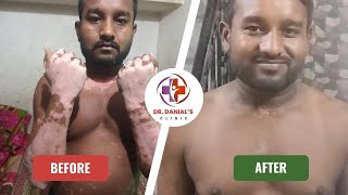 Transformative 5Month Vitiligo Treatment Journey  Dr Danials Clinic Review [upl. by Eillime453]