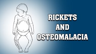 RICKETS AND OSTEOMALACIA [upl. by Goldenberg252]