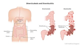 Differences between Diverticulosis and Diverticulitis [upl. by Bouley]