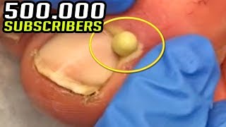 500000 Cysts Blackheads amp Ingrown Nails Thank You Video [upl. by Sotos]