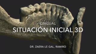 Regeneración ósea del propio paciente sin injertos  Implantes dentales [upl. by Perretta]