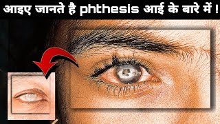 क्या आप जानते है Phthisis eye के बारे में  phthisis eye in Hindiphthisis eye  phthisis bulbi eye [upl. by Gwenette]