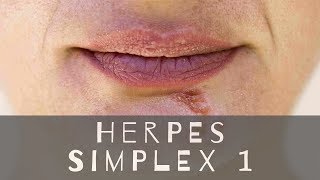 How to Get Rid of Herpes Simplex 1  HSV 1 Genital Herpes Symptoms Natural Cure and Treatment [upl. by Ashlee]