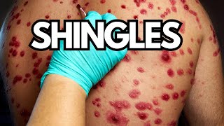 The Shingles Dilemma Why Seniors Need to Protect Themselves [upl. by Merriott]