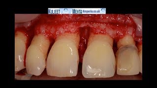 Periodontal Surgery Upper Front Teeth [upl. by Almeta182]