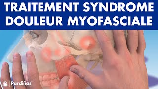 TRAITEMENT du Syndrome de DOULEUR MYOFASCIALE avec physiothérapie © [upl. by Cia262]