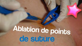 Ablation de points de suture [upl. by Nefets]