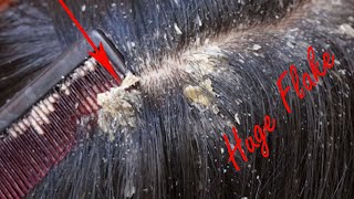 Remove Dandruff Flakes Satisfying Big Dandruff Flakes Scratching on Sister Hair [upl. by Aruat]