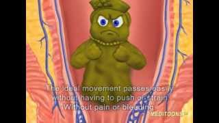 What Causes Hemorrhoids Treatment and Cure Meditoons™ [upl. by Nessim437]