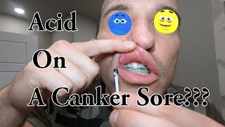 How To Get Rid Of Canker Sores Treatment [upl. by Anitahs]