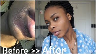 HOW TO Clear Acne  Hyperpigmentation ft Retin A  Am I Bleaching My Skin [upl. by Iana]