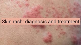 Skin Rash diagnosis and treatment [upl. by Higgins]