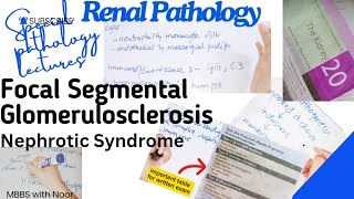 focal segmental glomerulosclerosis  nephrotic syndrome  renal pathology  selflessmedicose [upl. by Marr]