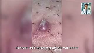 Ultimate Pimple Popping 2024 Powerful Acne Treatments [upl. by Relyhs]