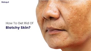 How To Get Rid Of Blotchy Skin [upl. by Fulbright]