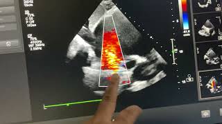 IVC type sinus Venosus ASD with partial anomalous pulmonary Venous connection ￼ [upl. by Ward]