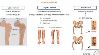 BONE DISORDERS AND TREATMENT [upl. by Bremble]