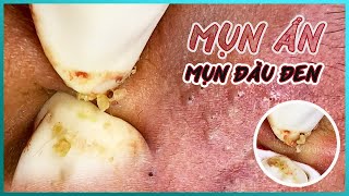 Big Cystic Acne Blackheads Extraction Blackheads amp Milia Whiteheads Removal Pimple Popping [upl. by Gewirtz]