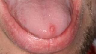 Putting salt on a canker sore Don’t do it cankersore canker dentist dentistry [upl. by Hanni]