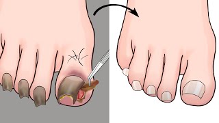 ASMR Ingrown Toenail Removal Treatment Animation  ENJO Relaxing [upl. by Docilu]