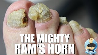 OVERGROWN RAMS HORN TOENAIL REMOVAL [upl. by Low804]