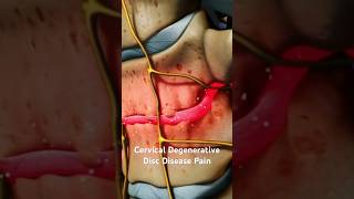 Cervical Degenerative Disc Disease Pain [upl. by Epp]