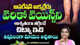 VaricoseVeins Treatment  Health Tips in Telugu  Relief from Nerve Swelling  Hi Tv Telugu [upl. by Aerdua]