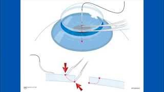 Corneal Suturing Part 2  Placing the Needle Into the Graft [upl. by Jard]