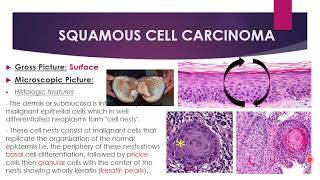 Disorders of growth and neoplasia  Malignant epithelial and mesenchymal tumors [upl. by Pas]