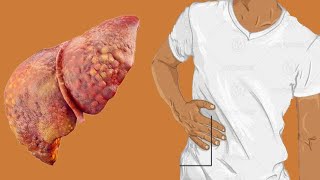 Cirrhosis Of Liver Life Expectancy By Stage [upl. by Aristotle]