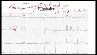 Hipokalemia EKG [upl. by Balliol]