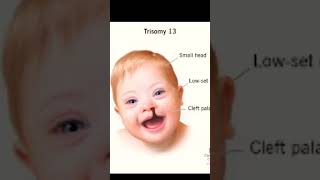 My creation trisomy 13 [upl. by Yduj]