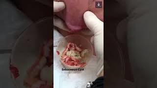 Cottage Cheese Sebaceous Cyst Drainage By DR Blackhead [upl. by Dor]