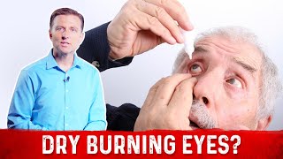 What Is Dry Burning Eyes amp How To Get Rid Of Dry Eyes – DrBerg [upl. by Maloy]