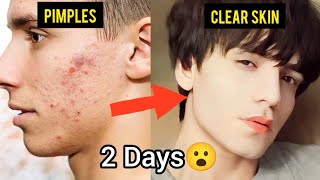 How to Get clear skin😍 just in 2 days😮 [upl. by Riess]