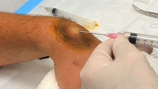 Ganglion Cyst Drained with BIG Needle  Neck Surgery Update [upl. by Olympe726]