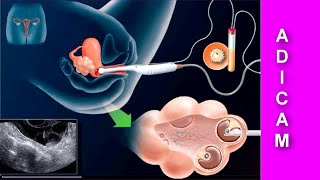 Herencia y Cáncer de Mama Aspectos reproductivos [upl. by Leissam]