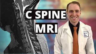 Neurologist Reviews Cervical Spine MRI Multiple Sclerosis with Enhancing Lesions [upl. by Vannie]