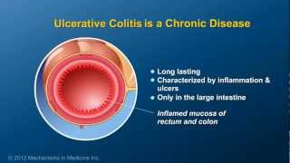 What is Ulcerative Colitis [upl. by Esille]