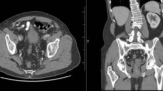 Unilateral renal seminal vesicle and Vas deferens agenesis [upl. by Forkey]