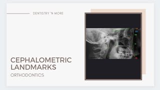 CEPHALOMETRIC LANDMARKS [upl. by Aihgn358]