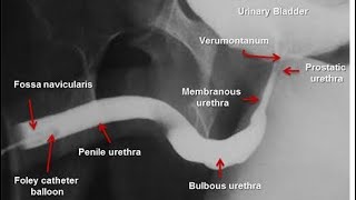 Retrograde Urethrogram  Ascending urethrography [upl. by Laird]