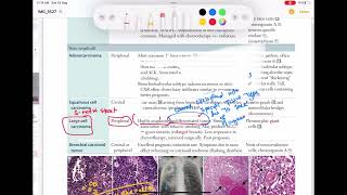 Large cell carcinoma of lung Respiratory 57  First Aid USMLE Step 1 in UrduHindi [upl. by Normie]