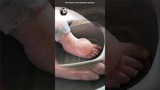 Should you pop your Blisters 💣🤯 [upl. by Ibor]